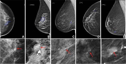 Can AI-Powered Virtual Biopsies Improve Detection of Breast Lesion Subtypes on Digital Mammography?