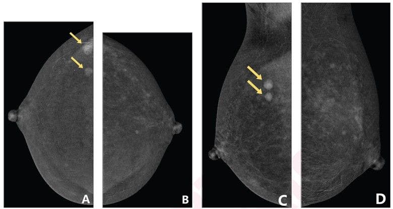 Contrast-Enhanced Mammography Study Examines Impact of Clinical Factors on Background Parenchymal Enhancement