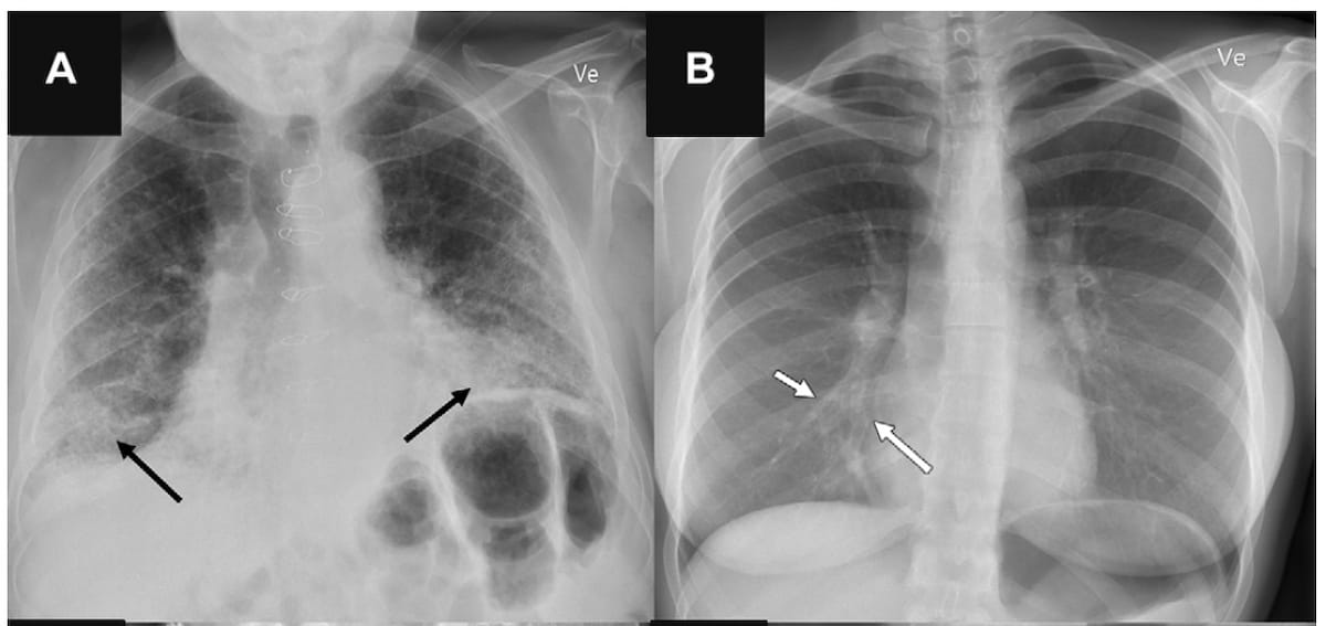 Study Raises Doubt About AI Sensitivity for Smaller and Multiple Findings on Chest X-Rays