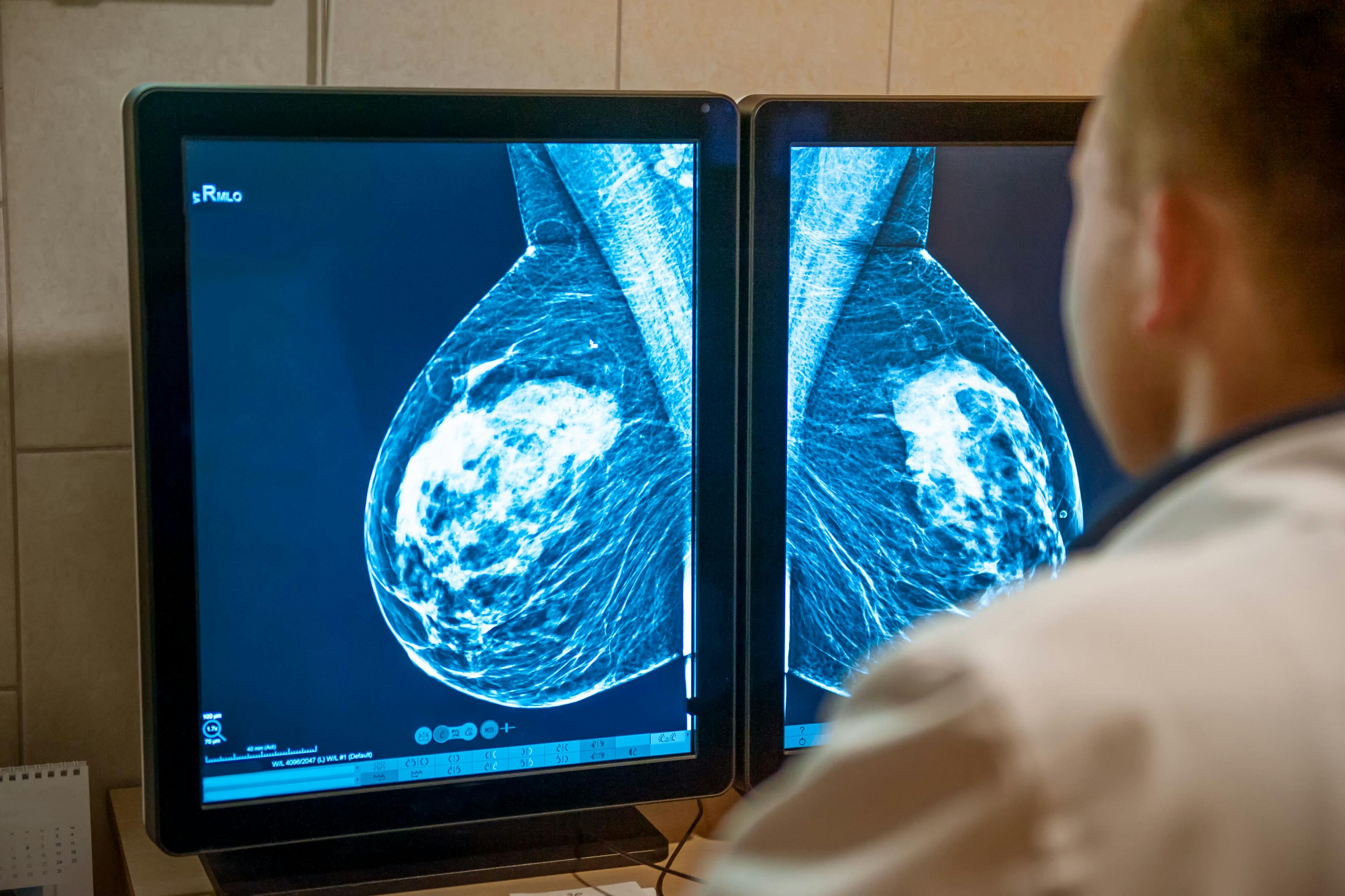Prereading of Screening Mammograms by Technologists May Not Improve Interpretation