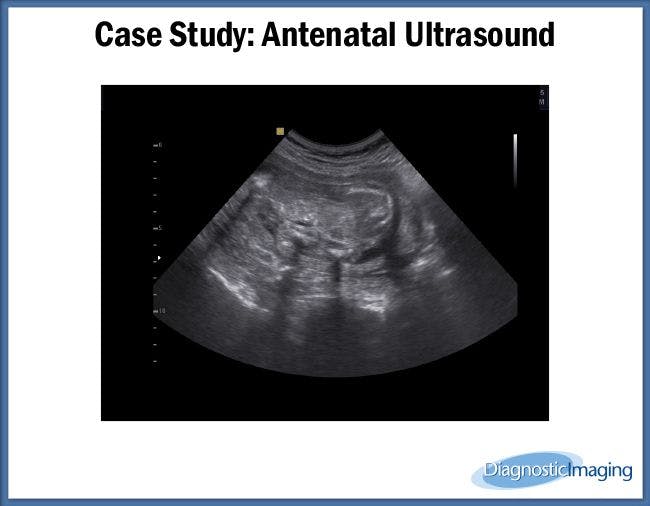 Antenatal Ultrasound