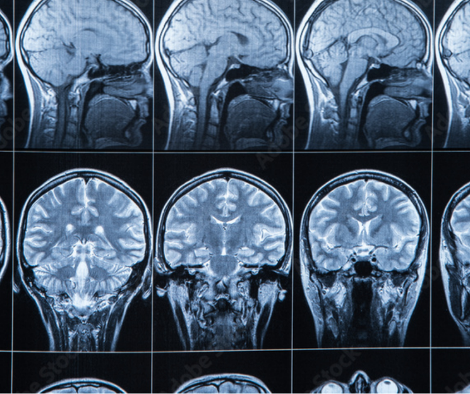 Aidoc Gets FDA 510(k) Clearance for AI-Powered Algorithm for Brain Aneurysms