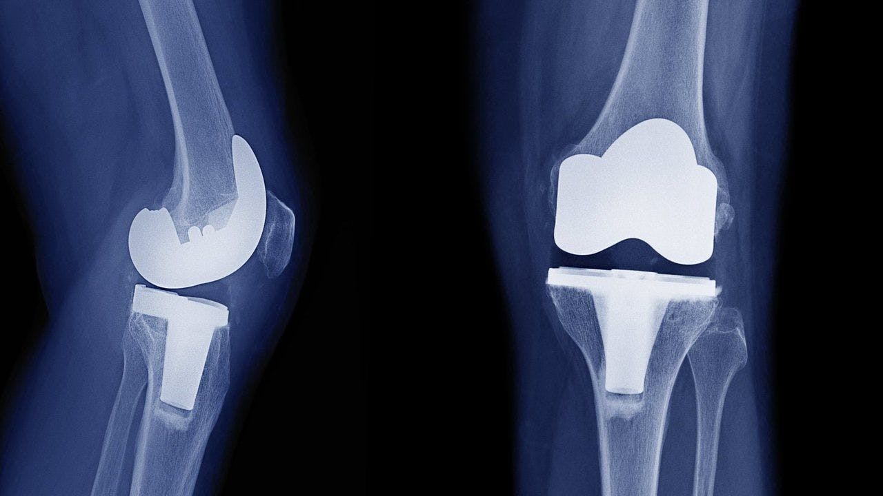 AI Tool Helps Reduce Re-Take Knee X-rays