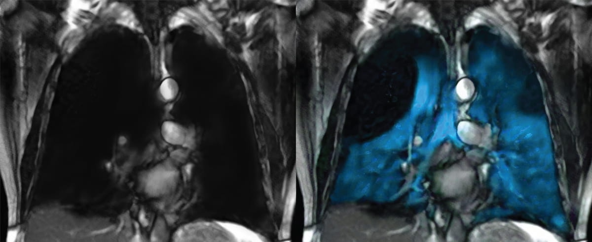 Collaboration Between Philips and Polarean Allows Routine MRI Access to High-Res Imaging of Lung Ventilation 