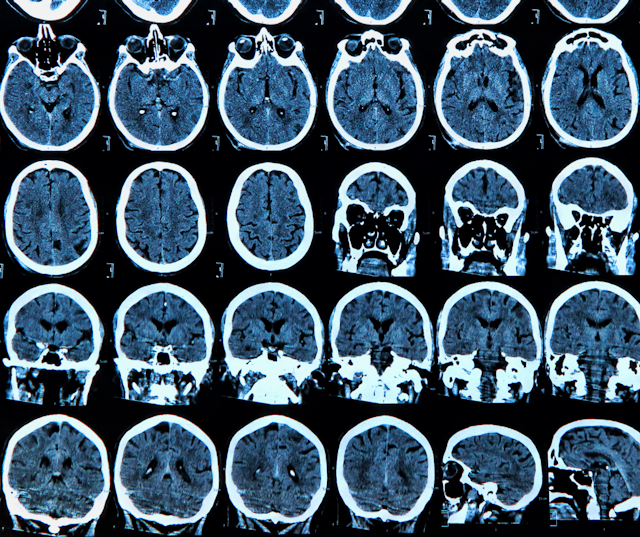 Emerging AI Software for Brain MRI Gets FDA Nod