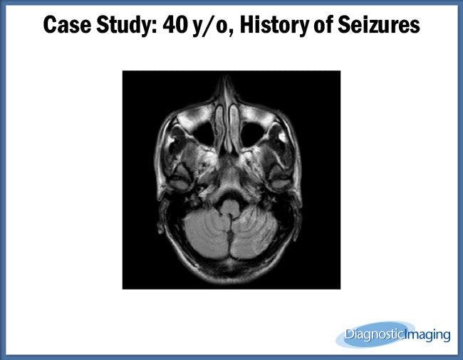40 y/o, History of Seizures