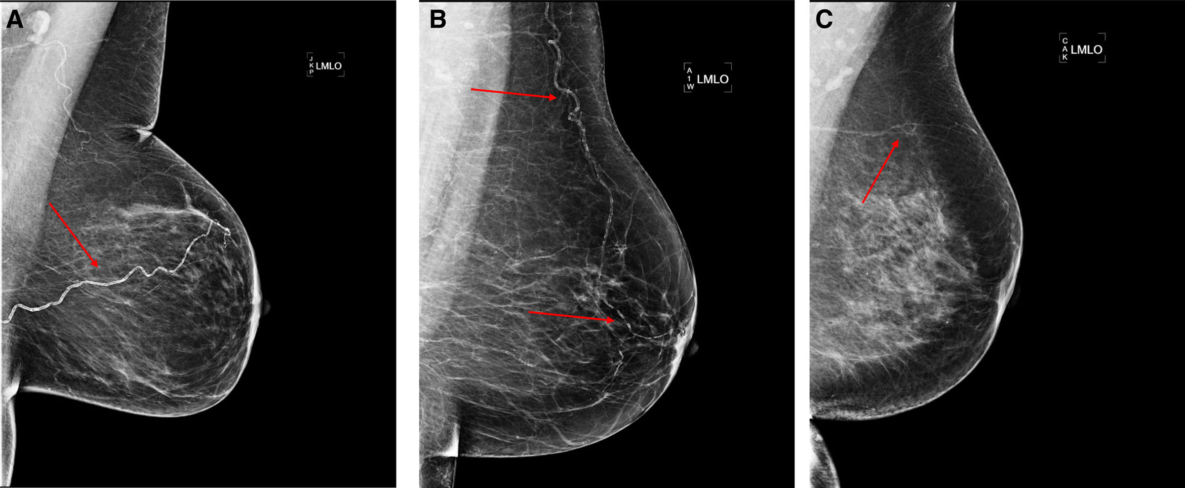 Study Shows Link Between Breast Arterial Calcification and Significant Cardiovascular Risks