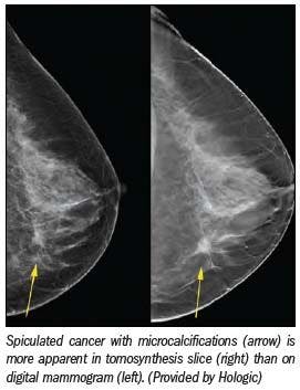 Breast tomosynthesis gets ready for U.S. market