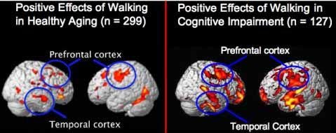 Walking, light exercise may prevent Alzheimer’s, osteoarthritis