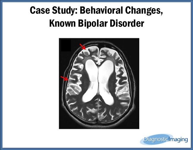 Behavioral Changes, Known Bipolar Disorder