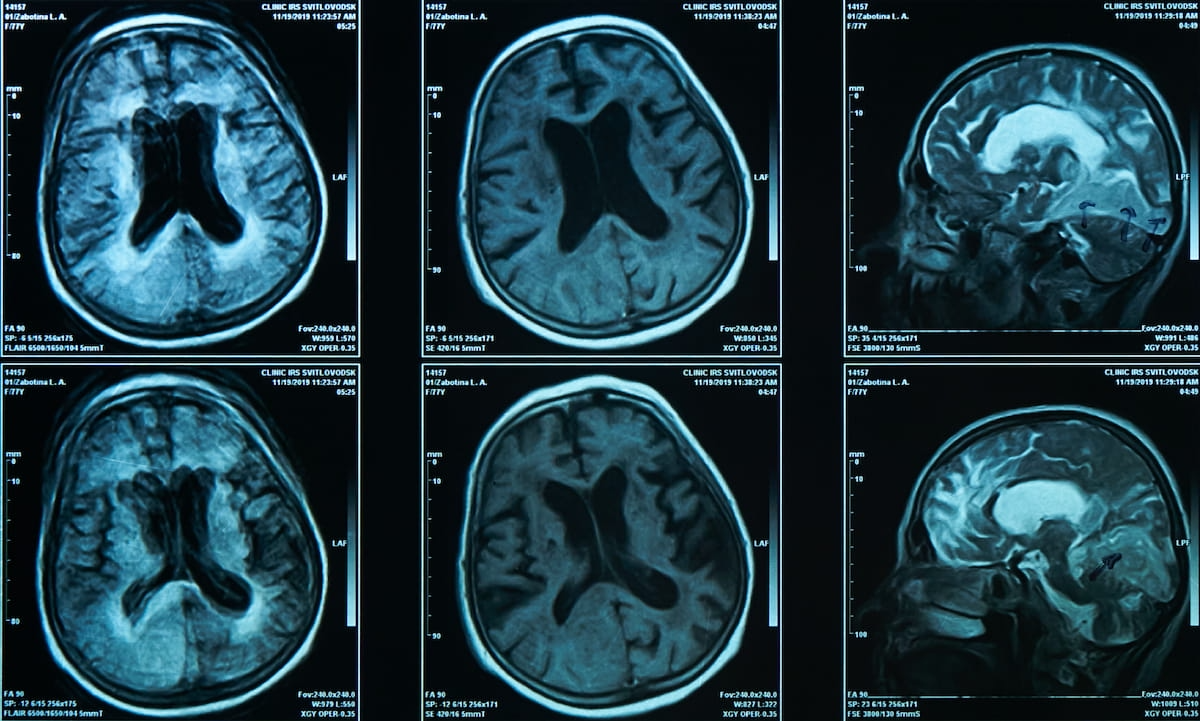 FDA Clears AI-Powered MRI Software to Assess for Brain Atrophy 