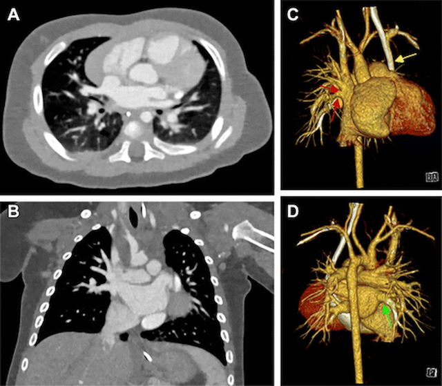 Can Photon-Counting CT Have an Impact in Diagnosing Congenital Heart Defects in Young Children?