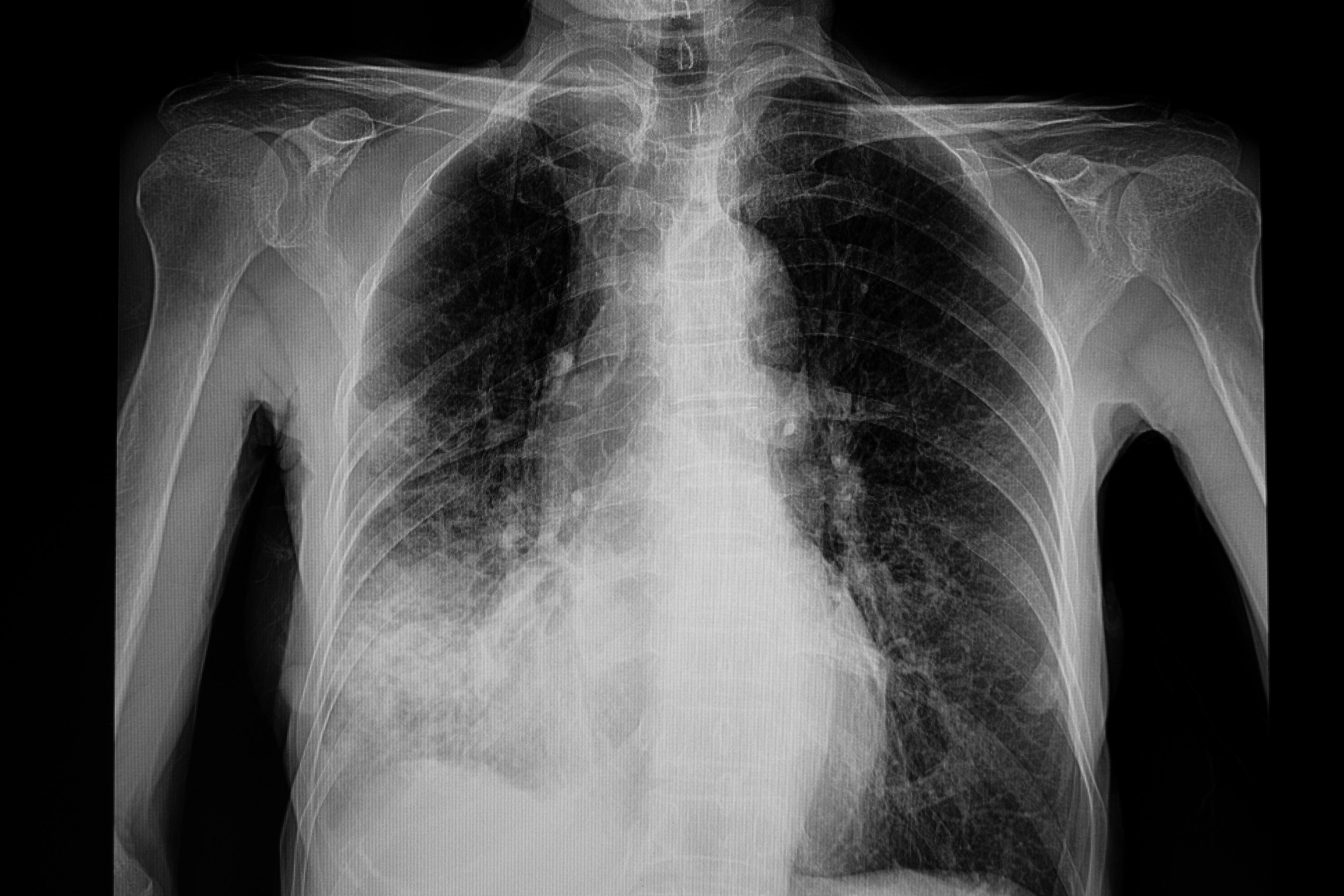 New Study Shows Impact of COVID-19 and Comorbidities in Inner-City Lung Screening Cohort