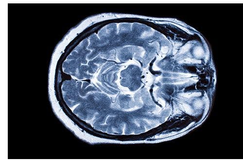 MRI Shows Iron Level Changes in Brain of MS Patients