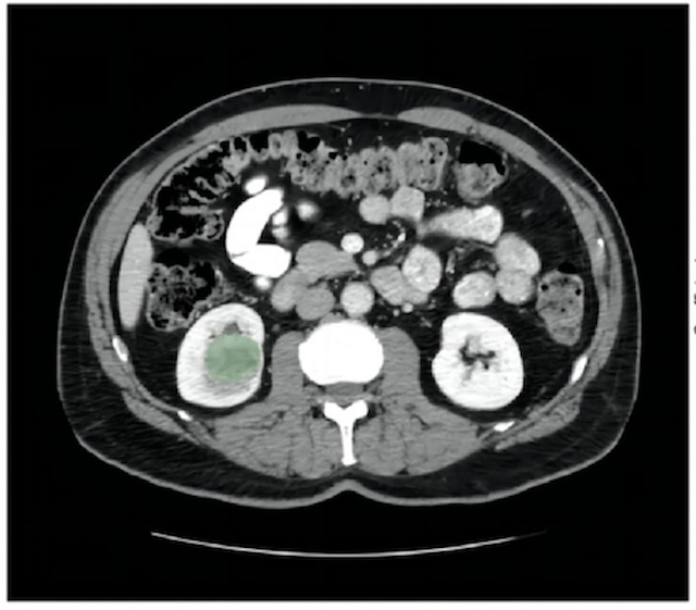 Can a CT-Based Radiomics Model Enhance Risk Stratification for Clear Cell Renal Cell Carcinoma?