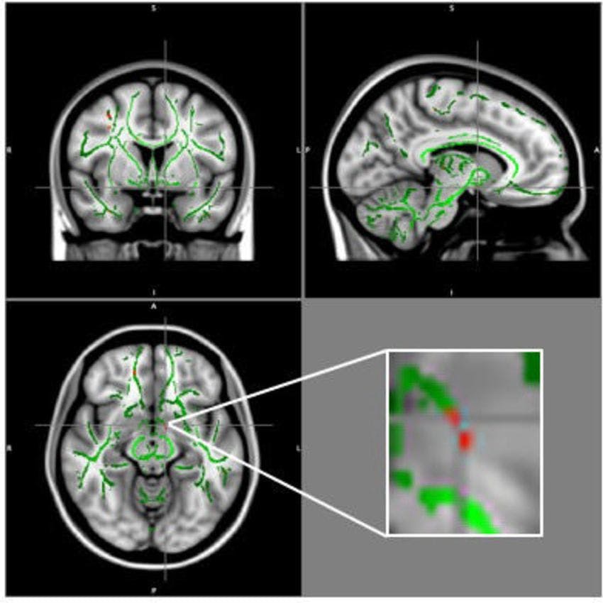 MRI Shows Brain Changes in Obese Adolescents