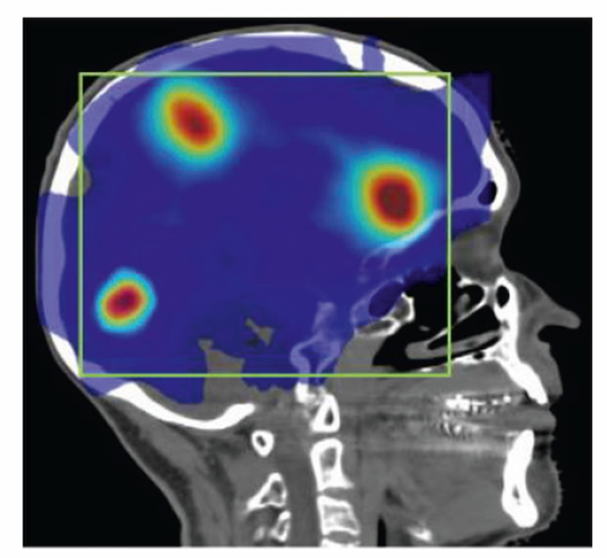 What Does the Future Hold for Brain Imaging and Radiotherapy?