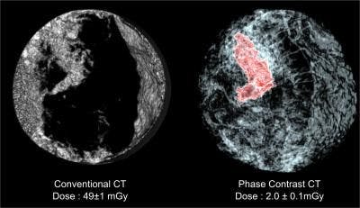 Novel Breast CT Provides Higher Resolution, Lower Dose