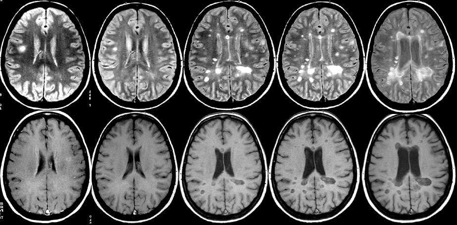 Advanced MRI May Speed Diagnosis of Multiple Sclerosis 