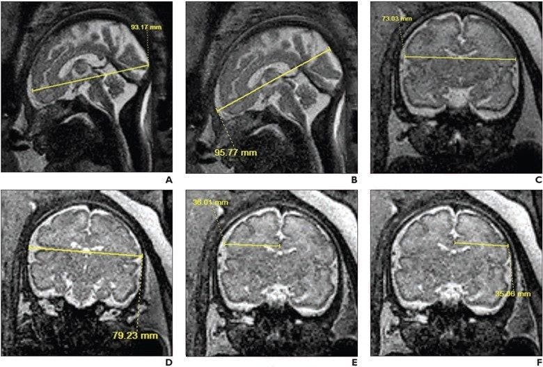 Prospective MRI Study Reveals Impact of Opioid Exposure on the Fetal Brain