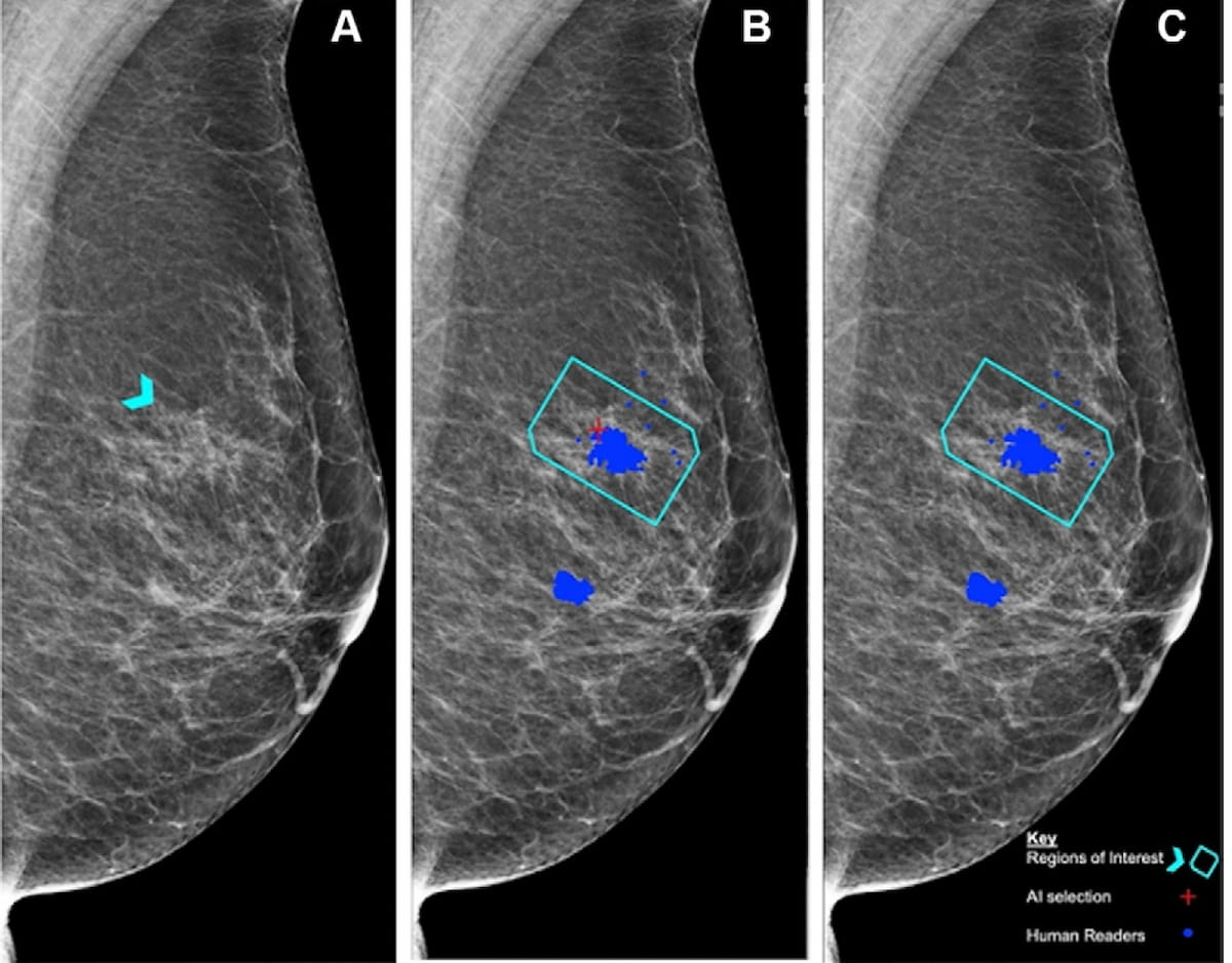 Can AI Match Radiologist Assessment of Screening Mammography Exams?