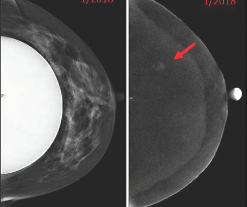 Study Highlights Use of Contrast-Enhanced Mammography in Women with Breast Implants
