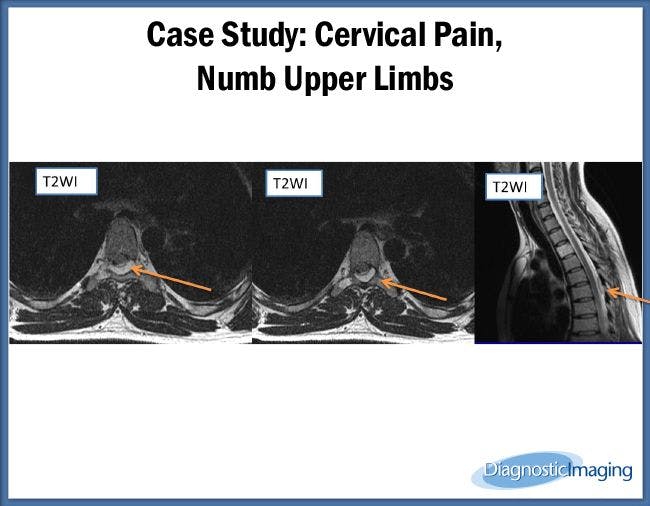 Cervical Pain, Numb Upper Limbs