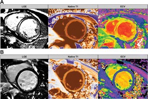 Could Cardiac MRI Improve Risk Stratification in Patients with Dilated Cardiomyopathy?