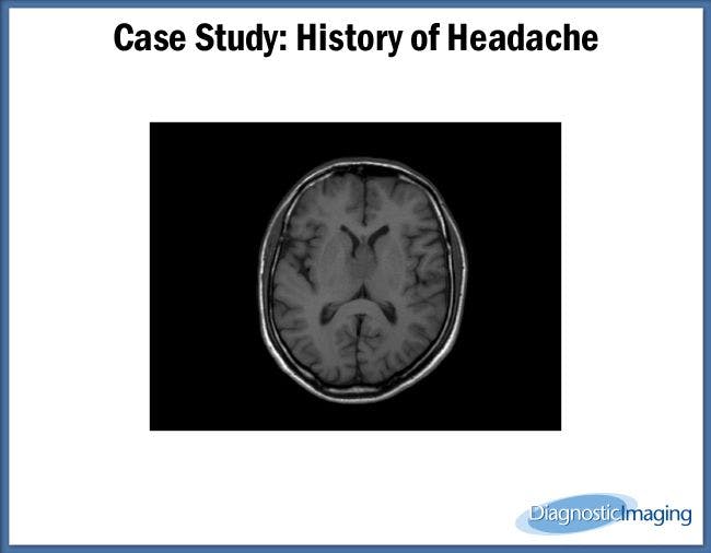 History of Headache