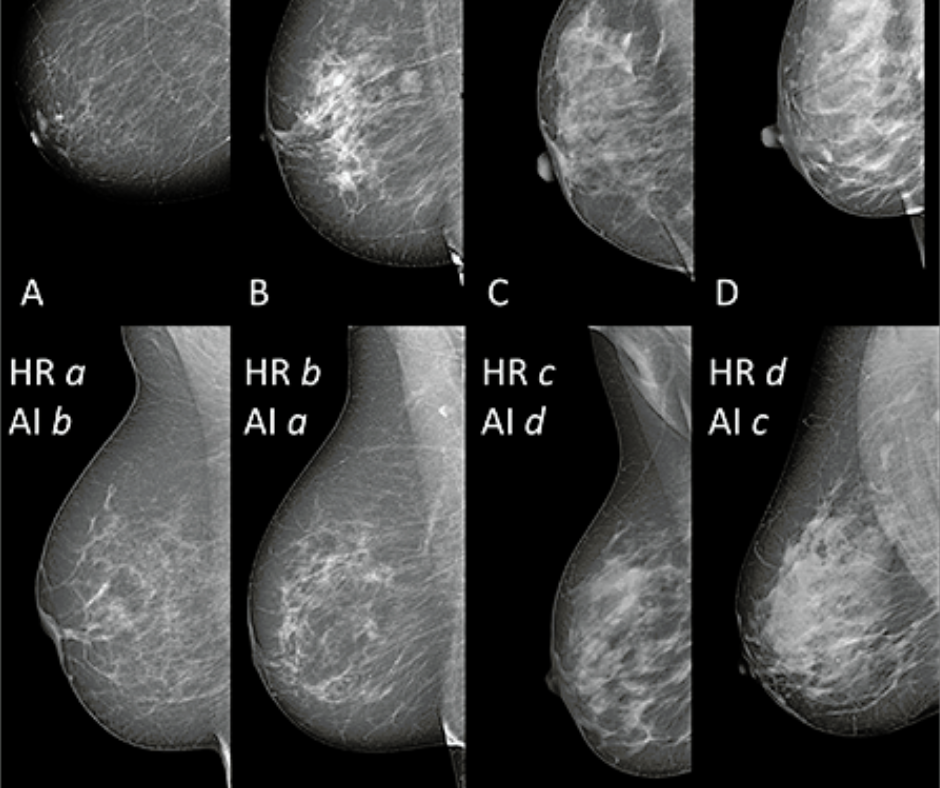Study Offers Closer Look at AI-Enabled Tool for Assessing Breast Density