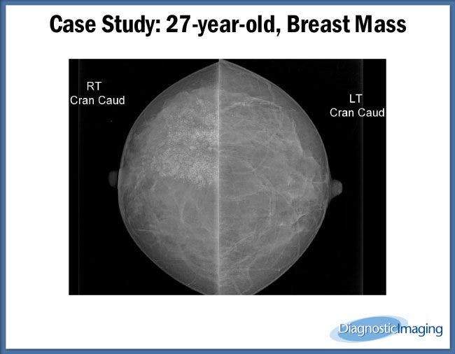 27-year-old, Breast Mass