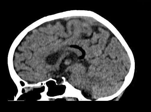Image IQ: 48-year-old Female, Complaint of Seizures