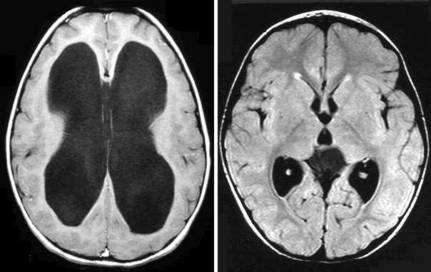 Low-field MRI Matches Standard-Of-Care Imaging for Hydrocephalus