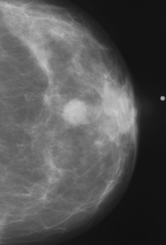Study: Regular Mammography Screening Reduces Breast Cancer Mortality Risk by More Than 70 Percent