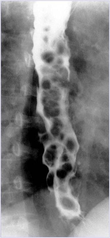 Image IQ Quiz: Patient Presents with Increasing Difficulty Swallowing