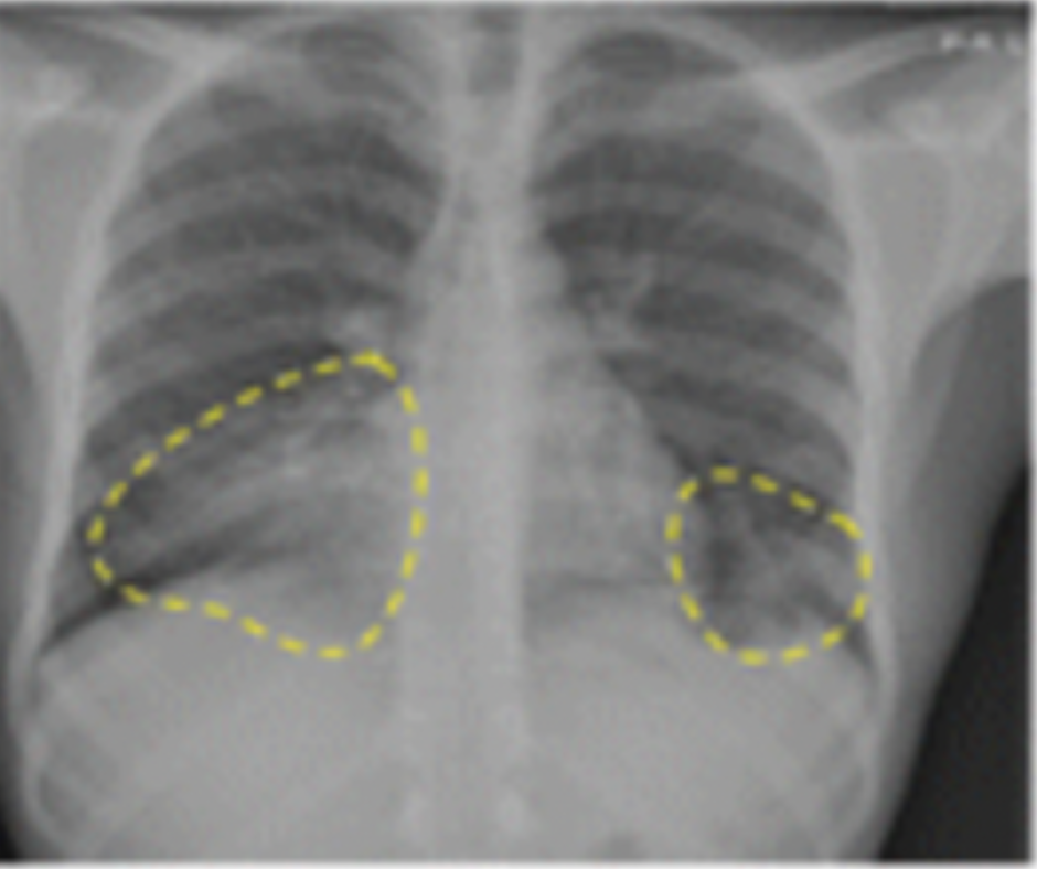 Study: Deep Learning System is Comparable to Radiologist Assessment of Chest X-Rays for Tuberculosis