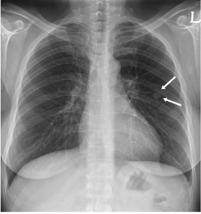 Images in a 48-year-old woman with 15-mm biopsy-proven metastatic carcinoma of parotid duct origin. Chest radiograph shows a well-defined nodule (arrows) in left middle lung zone that overlaps the anterior arc of the left fourth rib.

Credit: RSNA