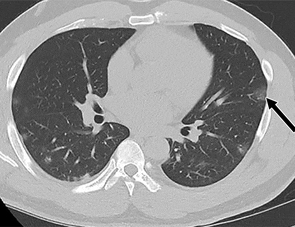 40-year-old man with abdominal pain and gastrointestinal symptoms. Axial CT of abdomen and pelvis shows multifocal subpleural ground-glass opacities (arrow) in visualized lungs. This nonspecific finding may be result of atypical infection such as coronavirus disease (COVID-19) pneumonia.  Courtesy: American Journal of Roentgenology