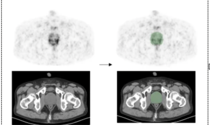 Could a New PSMA-Derived Radiomics Model Help Detect Intraprostatic Lesions on PET/CT?