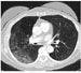 Low Dose CT for Lung Cancer May Assess Risk for Cardiovascular Event