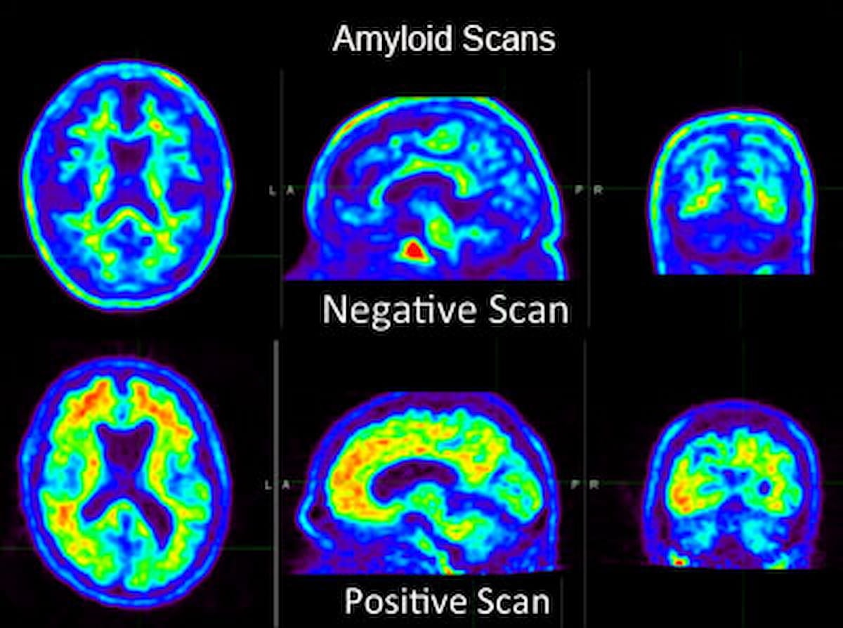 Study Finds Little Impact of Amyloid PET Scans on Reducing Hospitalization or ER Visits for People with Cognitive Decline