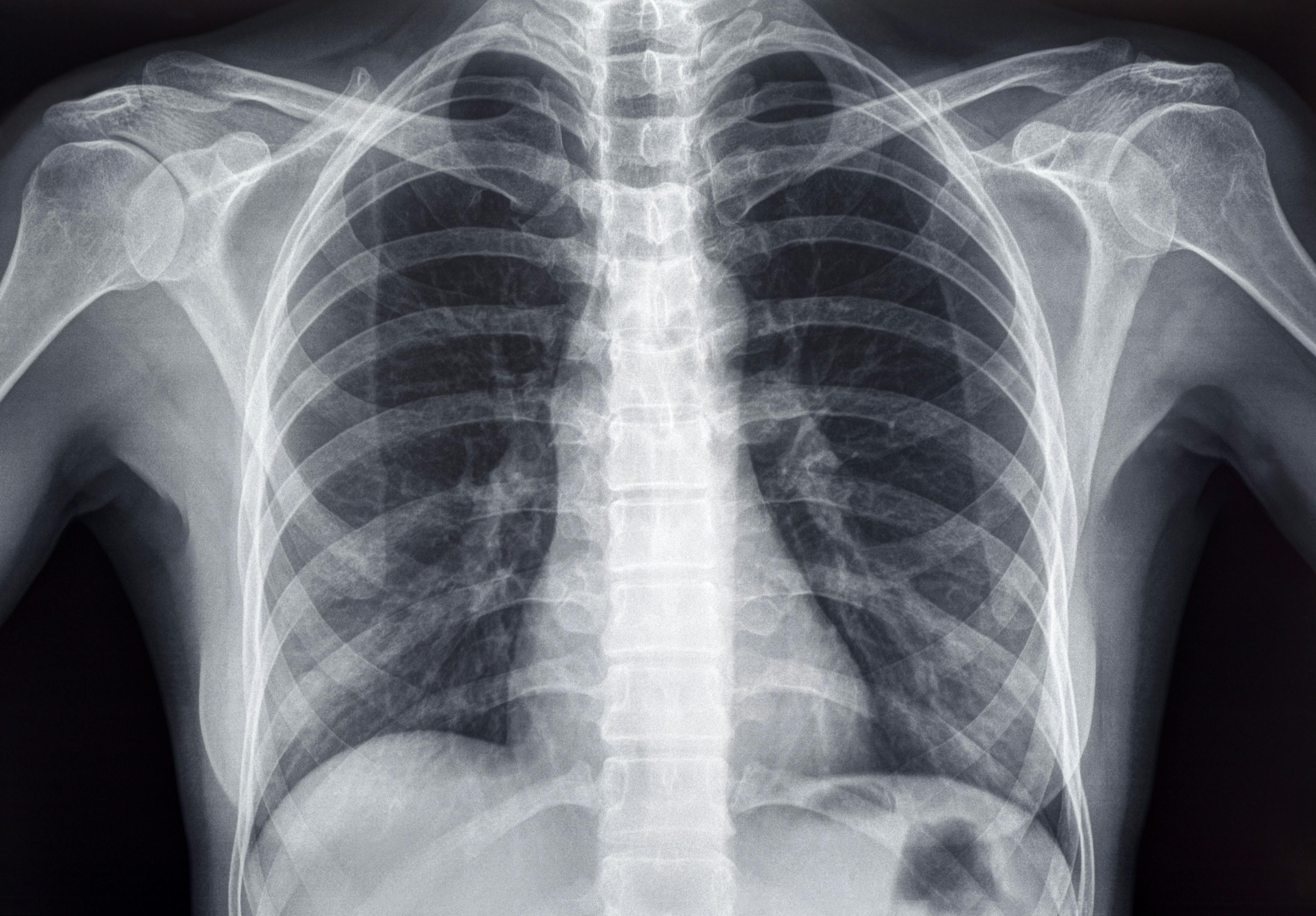 AI Trained on a Diverse Dataset Perform Better Chest X-ray Analysis