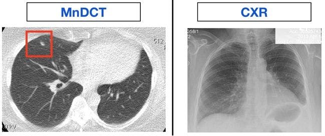 Low Dose Lung CT Finds More Cancers in Surgery Patients