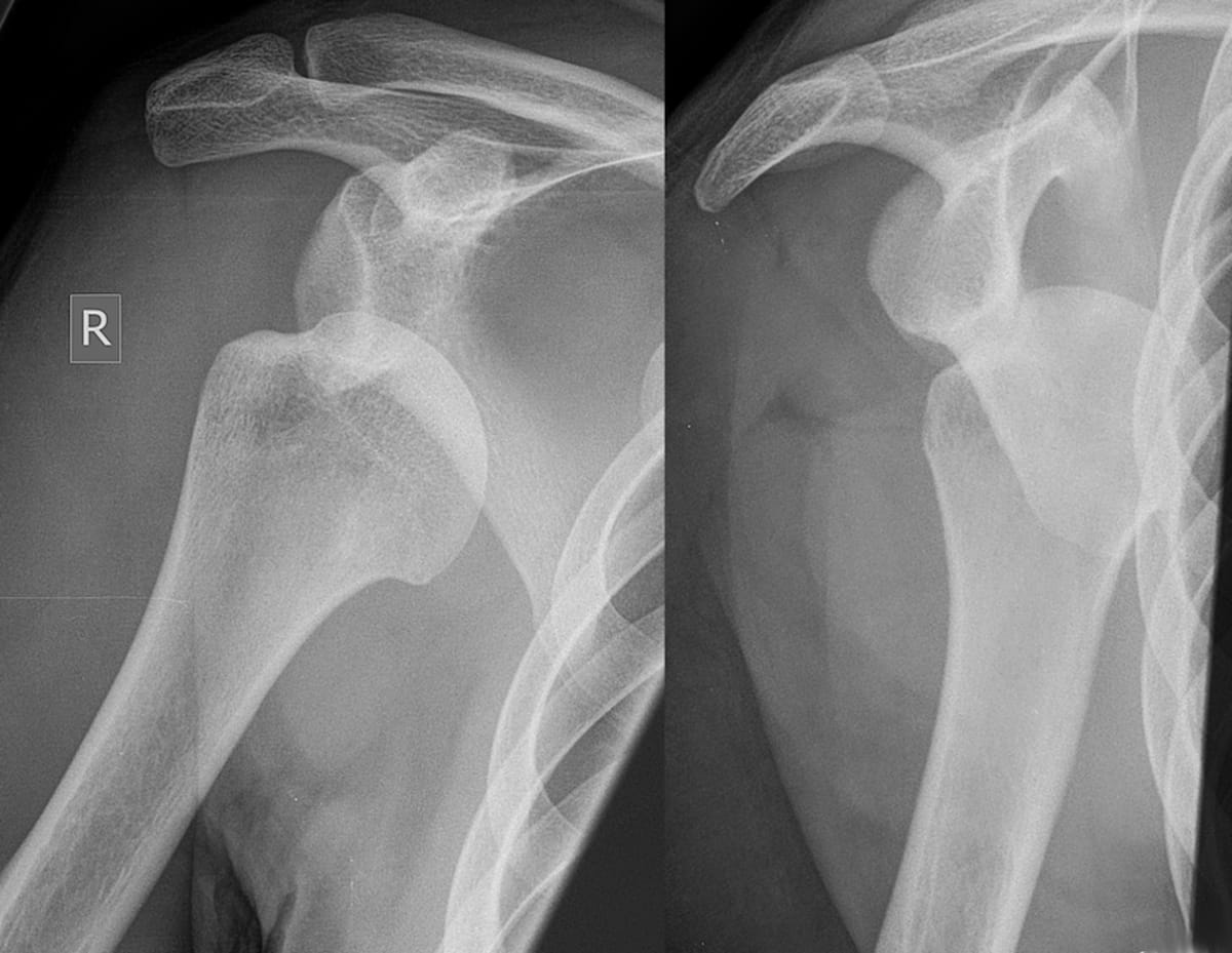 Image IQ Quiz: 45-Year-Old Basketball Player with Acute Shoulder Injury