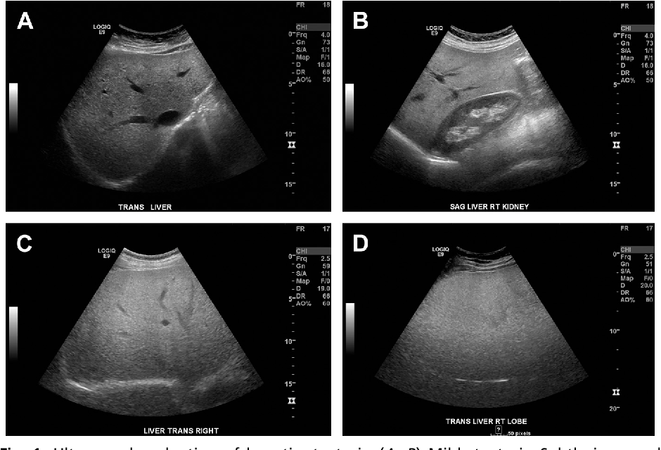Multiparametric Ultrasound Could Be Useful for Identifying Patients with High-Risk NASH