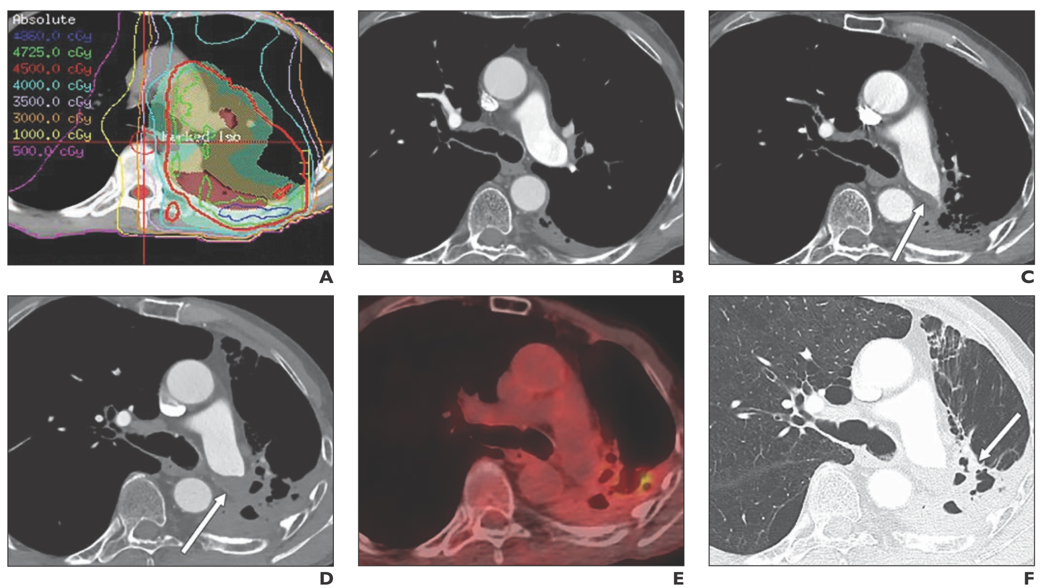 Pulmonary Artery Thrombosis: An Unrecognized Radiation Therapy Complication