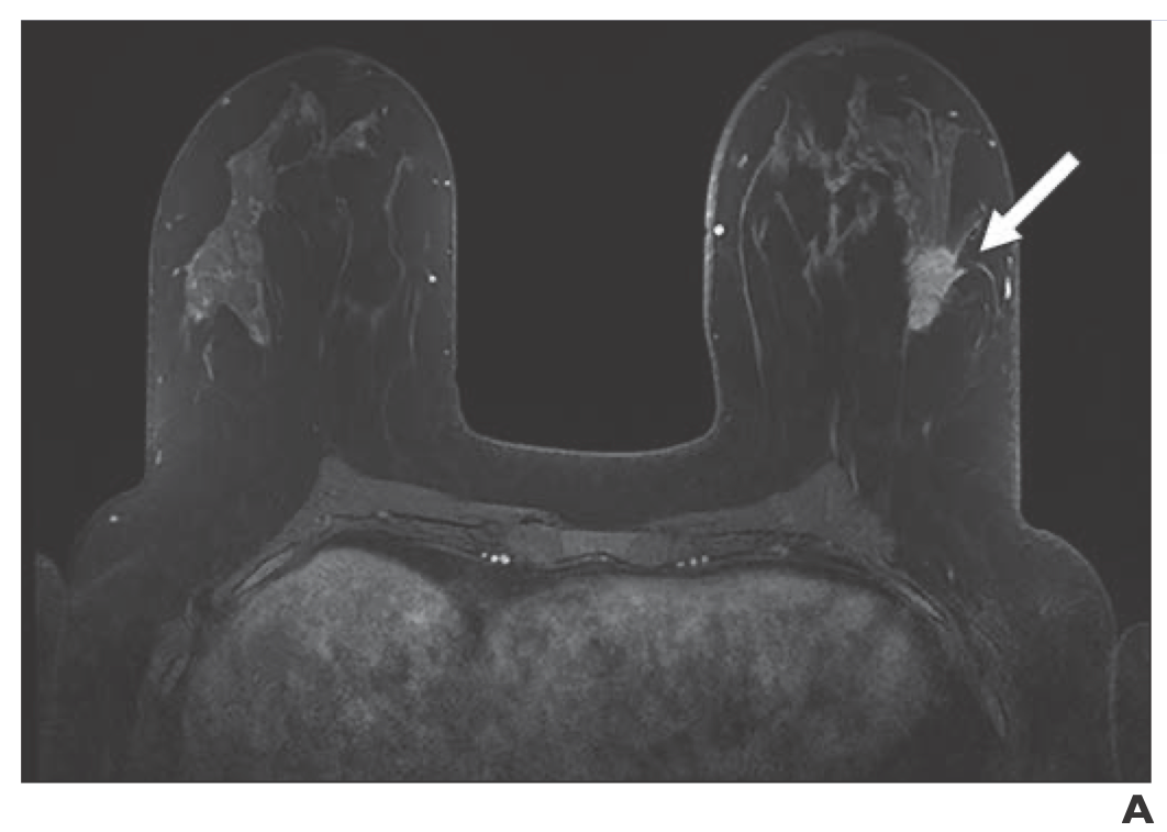 Breast MRI-Identified Lesions During Neoadjuvant Therapy Are Largely Benign
