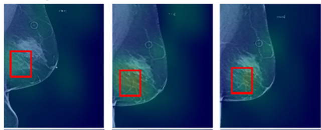 Mammography Study: Deep Learning Emphasis on Bilateral Dissimilarity May Clarify AI Assessments of Breast Cancer Risk