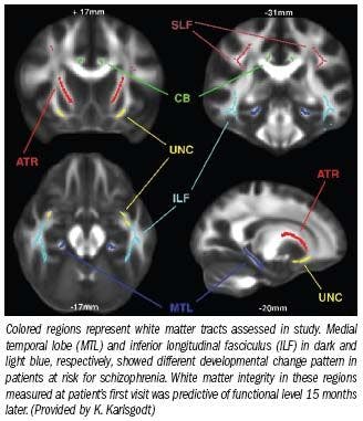 Diffusion tensor imaging charts path to schizophrenia