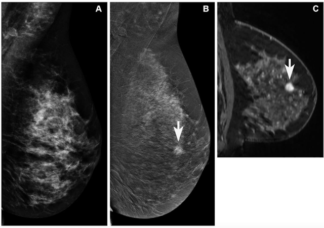 Study Says Contrast-Enhanced Mammography Offers Comparable Breast Cancer Detection to MRI 